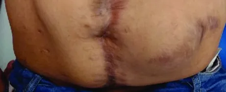 Obesity